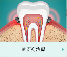 歯周病治療