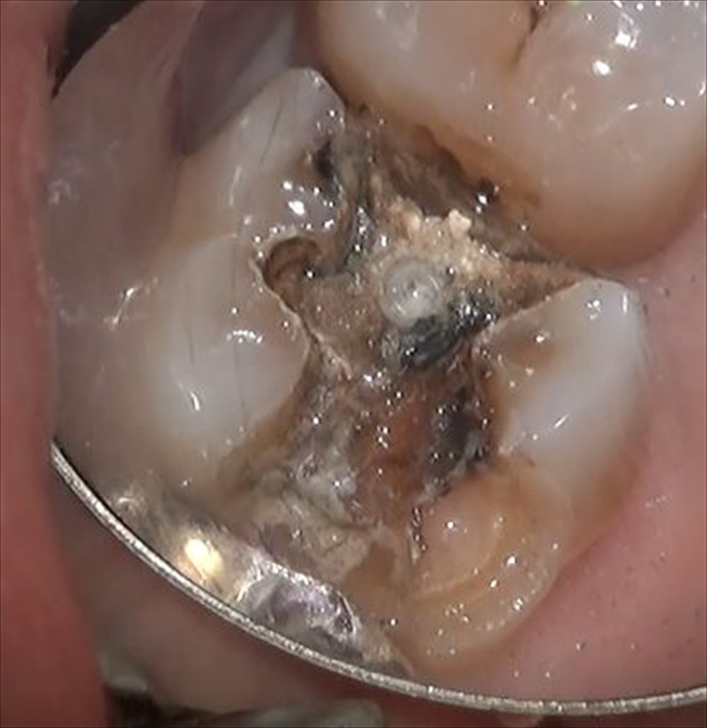 奥歯の銀歯の下に虫歯が 世田谷区千歳烏山でおすすめの歯医者 こまい歯科