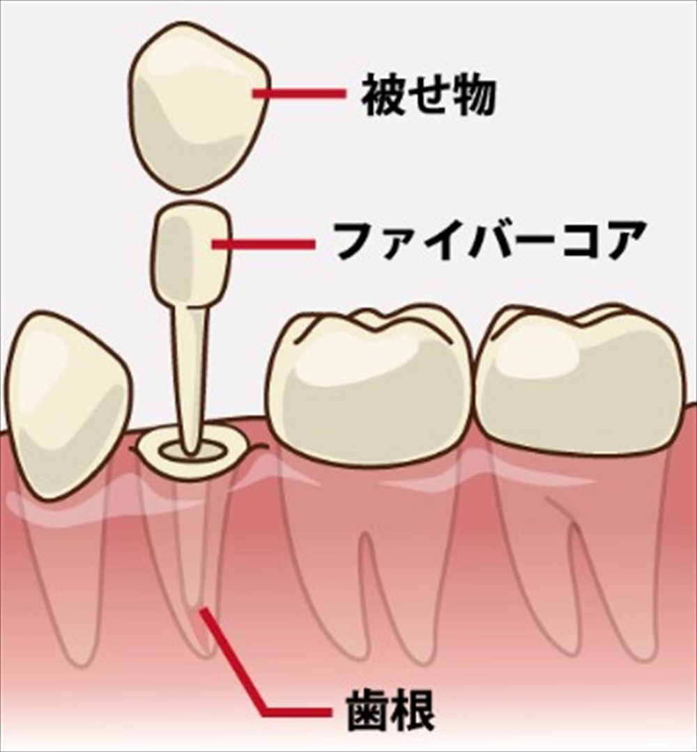 歯医者さんが教える！歯根破折に強い土台①