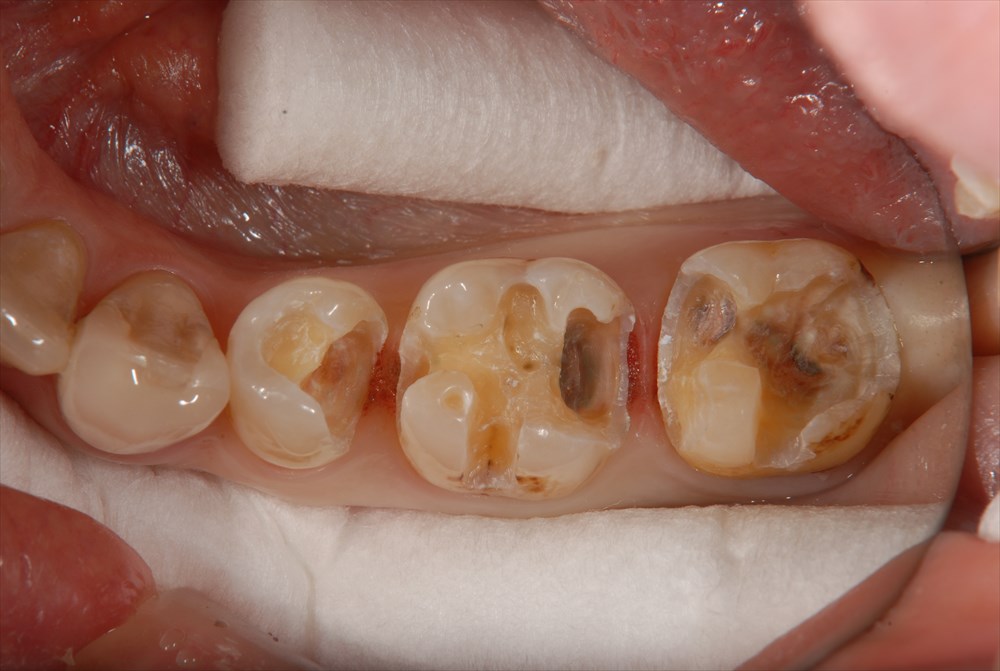 銀 歯 虫歯 に なる