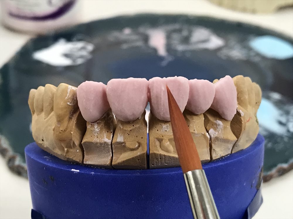 歯医者さんで入れるセラミックはこうして作られる④ | 世田谷区千歳烏山でおすすめの歯医者｜こまい歯科