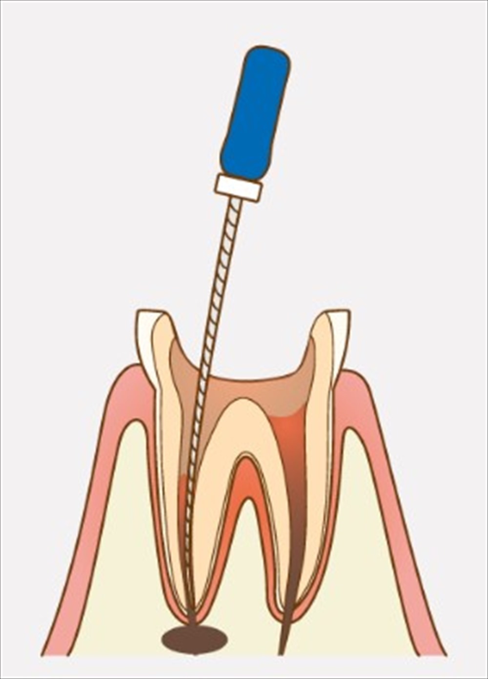 歯医者さんが教える！歯の神経を取ると痛みは消えるのか？
