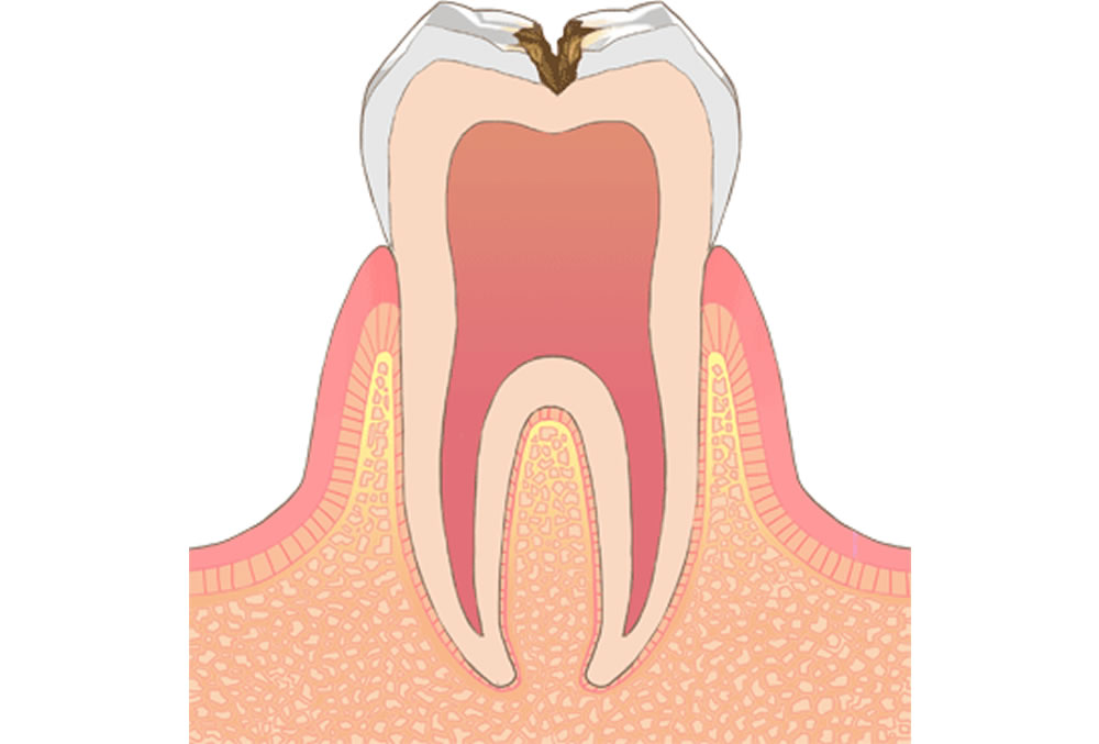 患者さんからの質問：虫歯って１日でも早く治療しないと悪くなるのでは？