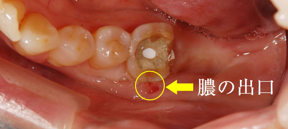 根管治療後の口腔ケア
