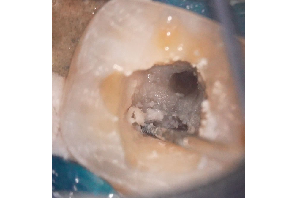 精密根管治療の実施(一番奥の歯)