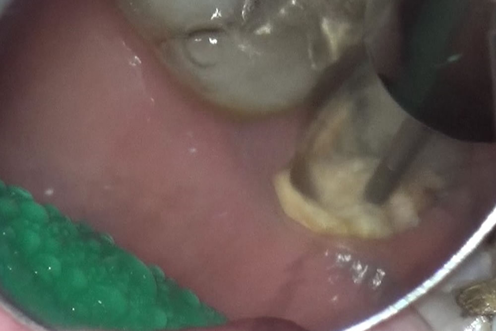 虫歯の除去～隔壁の形成
