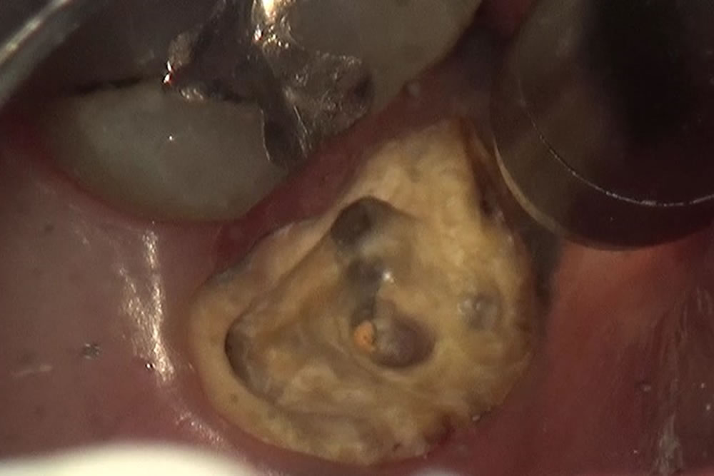 虫歯の除去～隔壁の形成