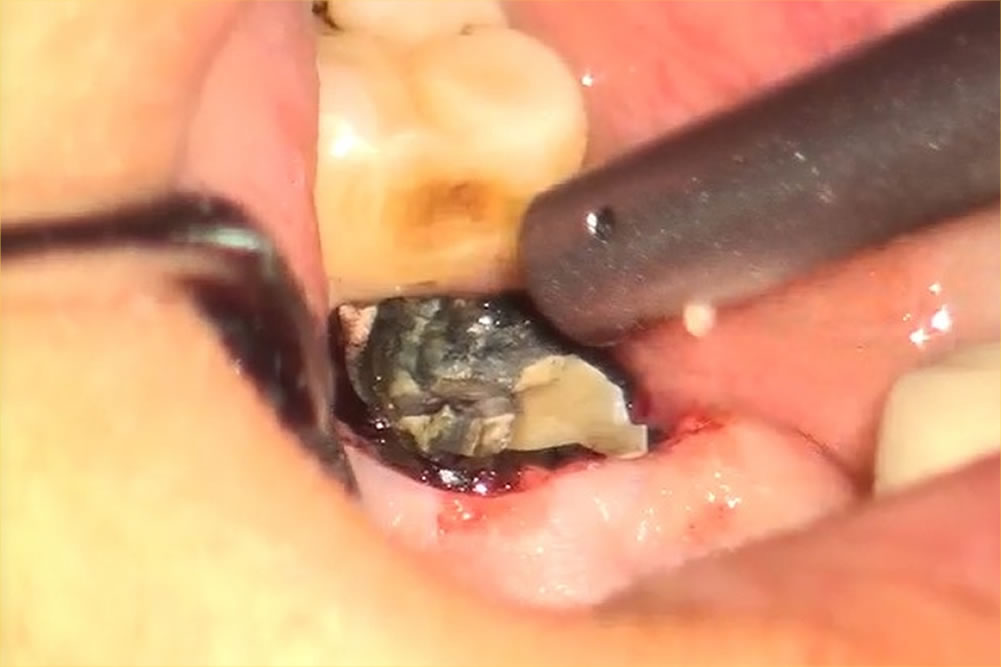 奥歯の抜歯