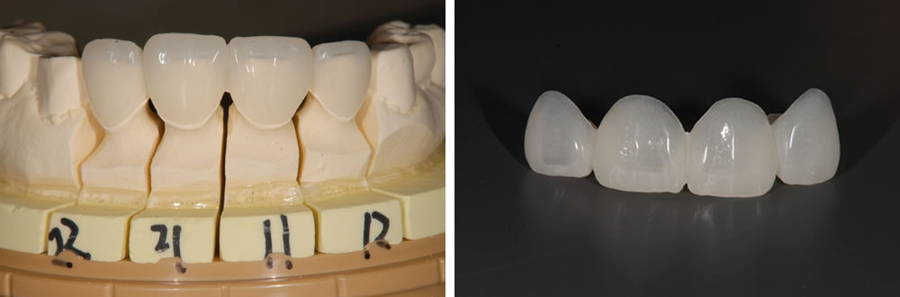 土台の歯の根管治療の実施・仮歯の装着