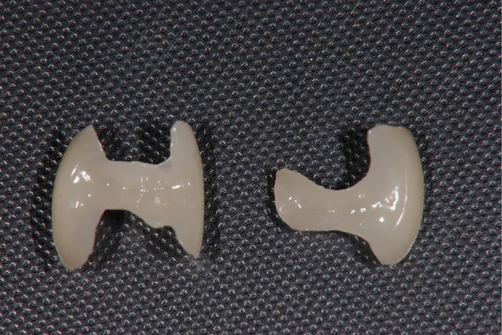 歯医者さん自身が治療を受ける際に選ぶ詰め物の材質