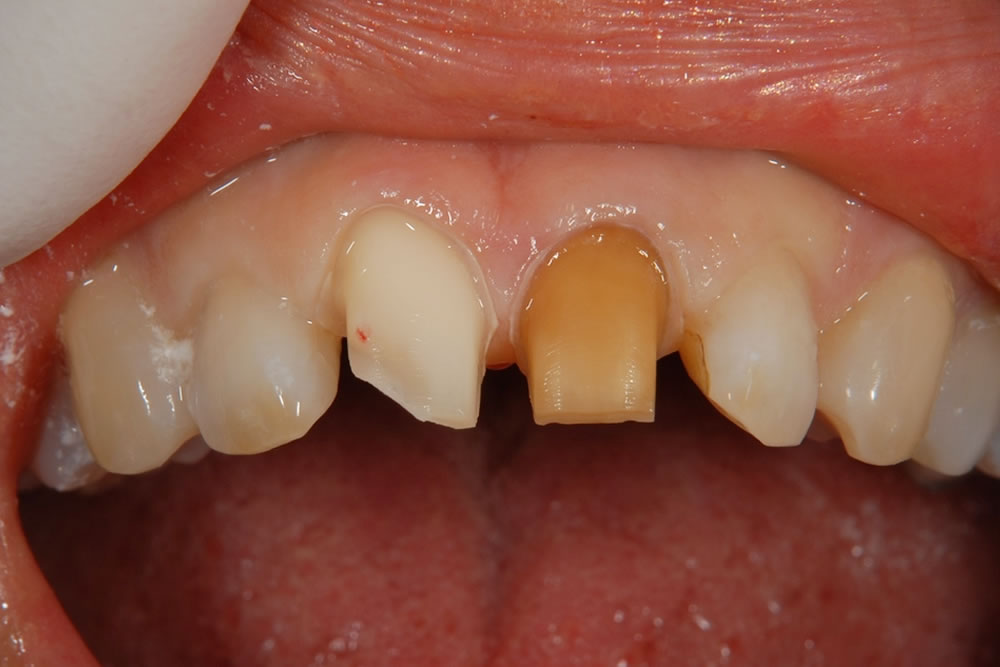 歯の形成処置