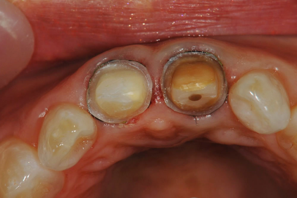 形成後の前歯