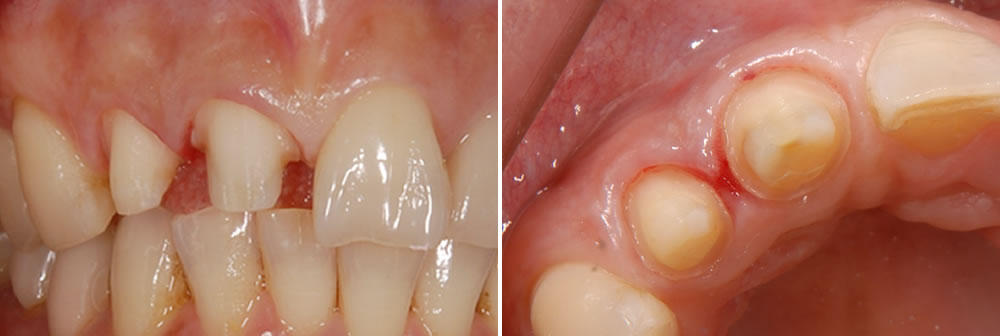 虫歯治療と歯の形成