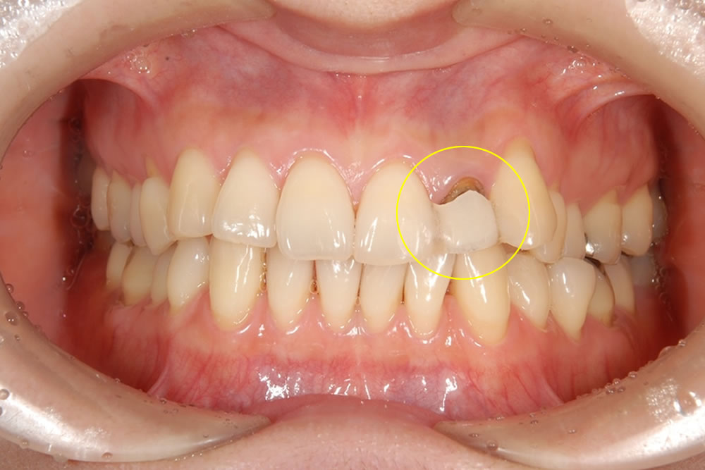 歯肉整形の実施