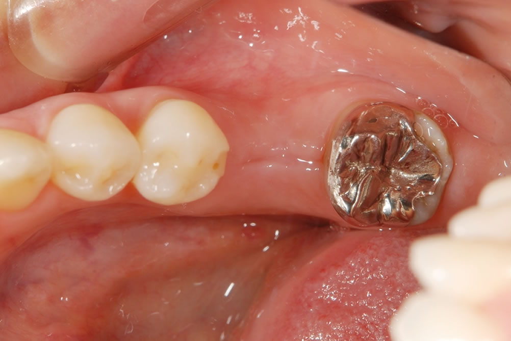 保存不可能な歯を抜歯
