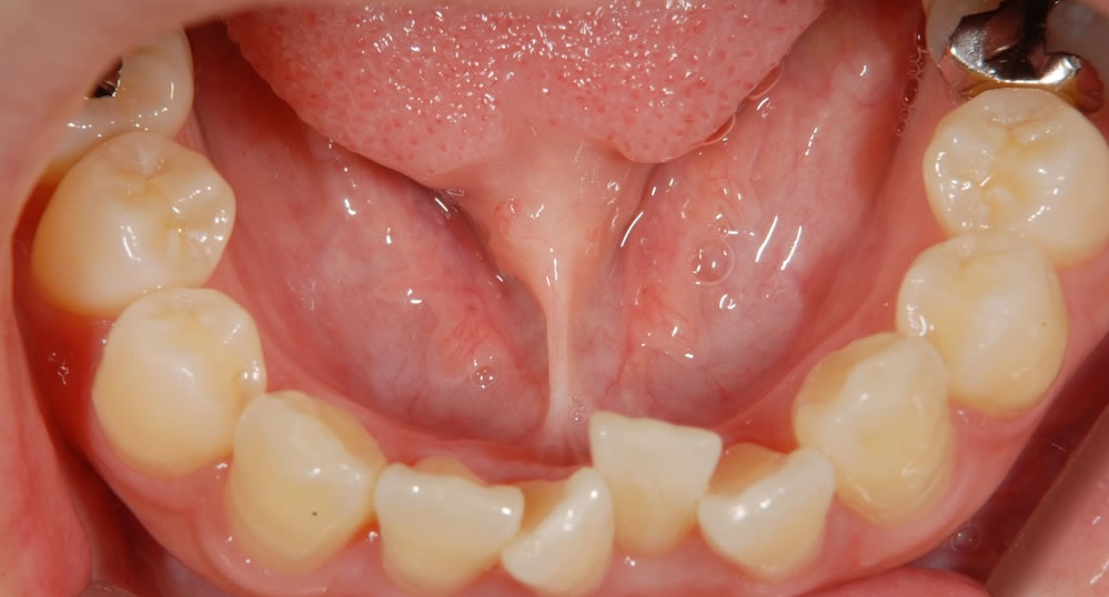 舌小帯短縮症の治療例
