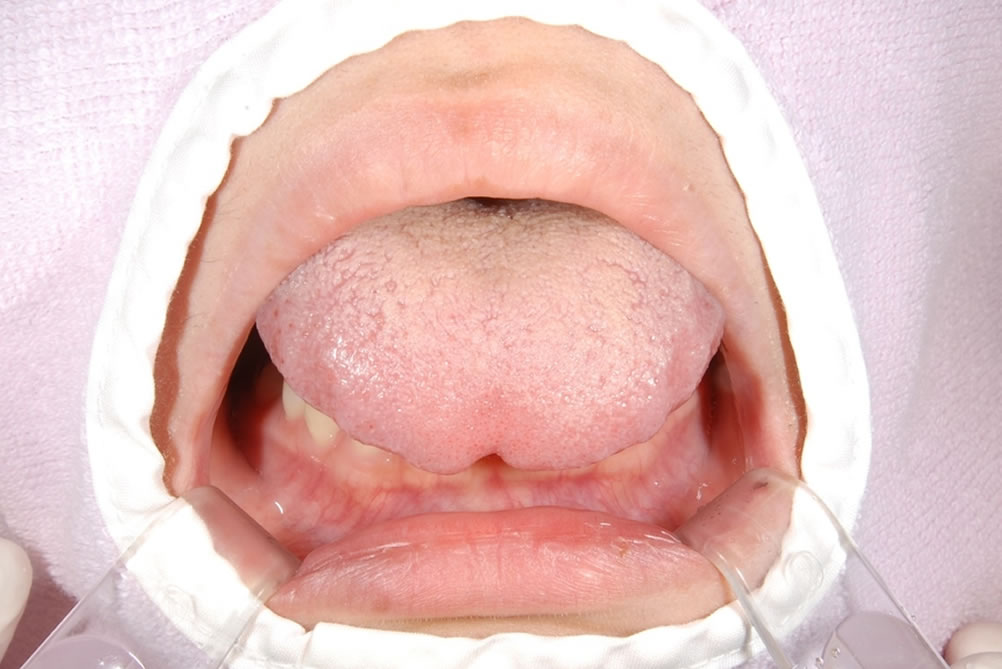 舌小帯短縮症の治療例