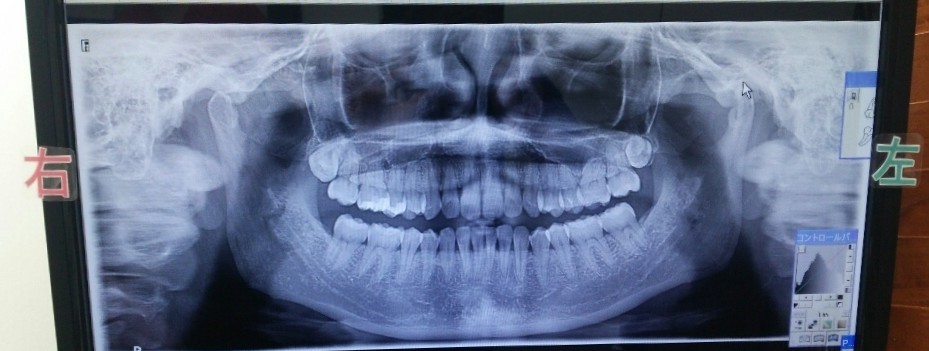 歯医者さんが教える！レントゲンを撮影すると何がわかるの？