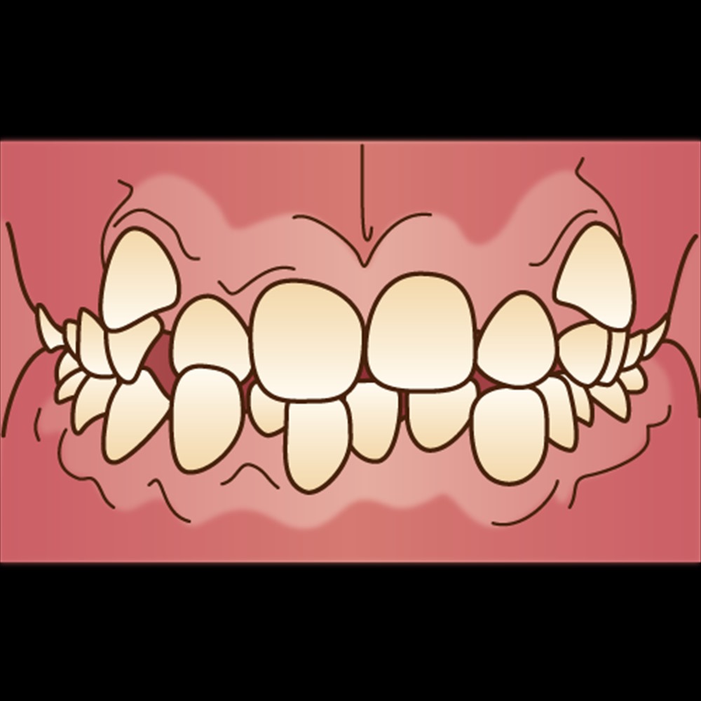 歯医者さんが教える！歯の矯正治療と抜歯の必要性②