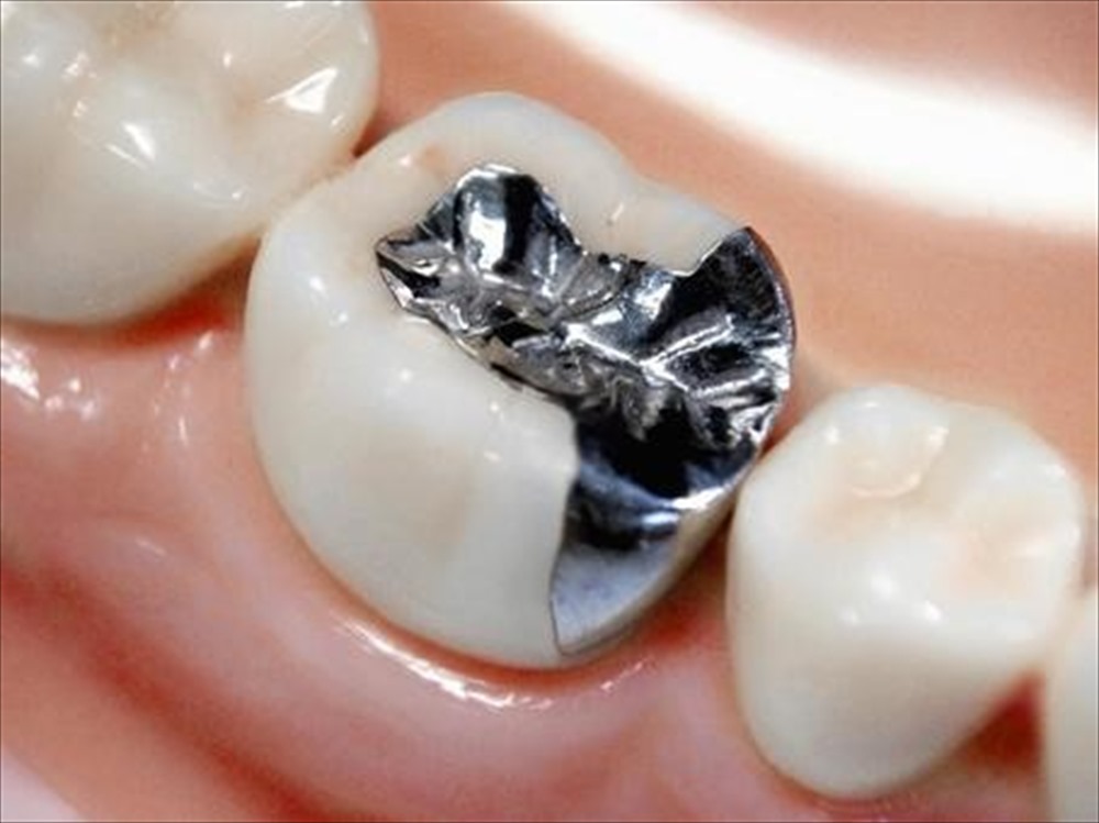 銀歯は虫歯になりやすいって本当？？