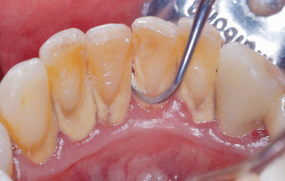 歯石をつきにくくする6つの方法