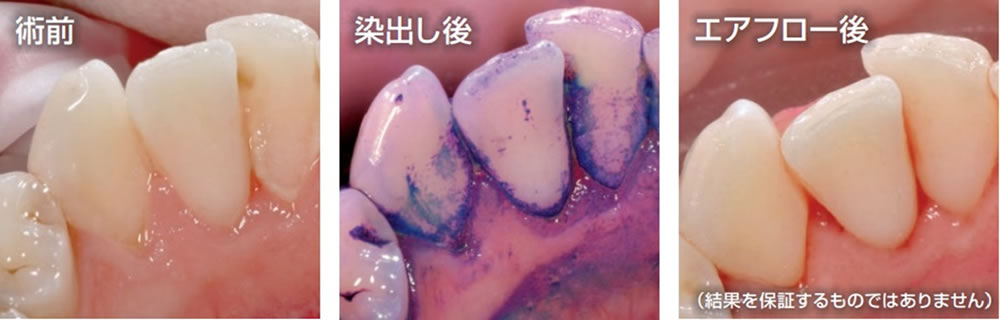 歯の除菌コース