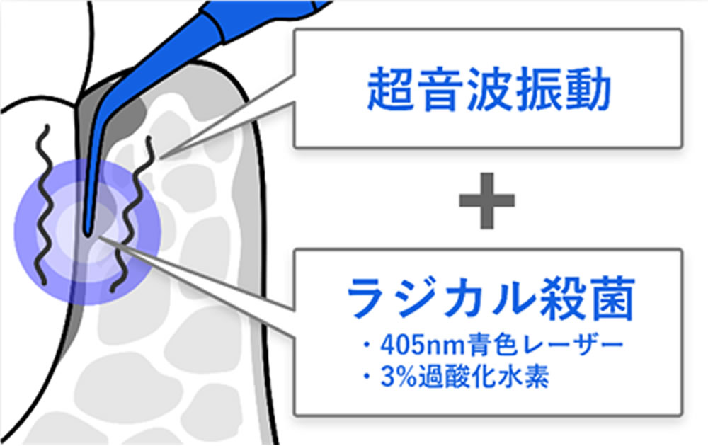 ブルーラジカル治療